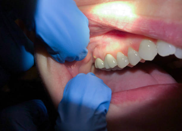 Best Emergency Broken Tooth Repair in Southside, AL