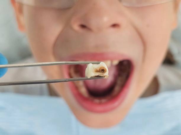 Best Emergency Wisdom Teeth Removal in Southside, AL